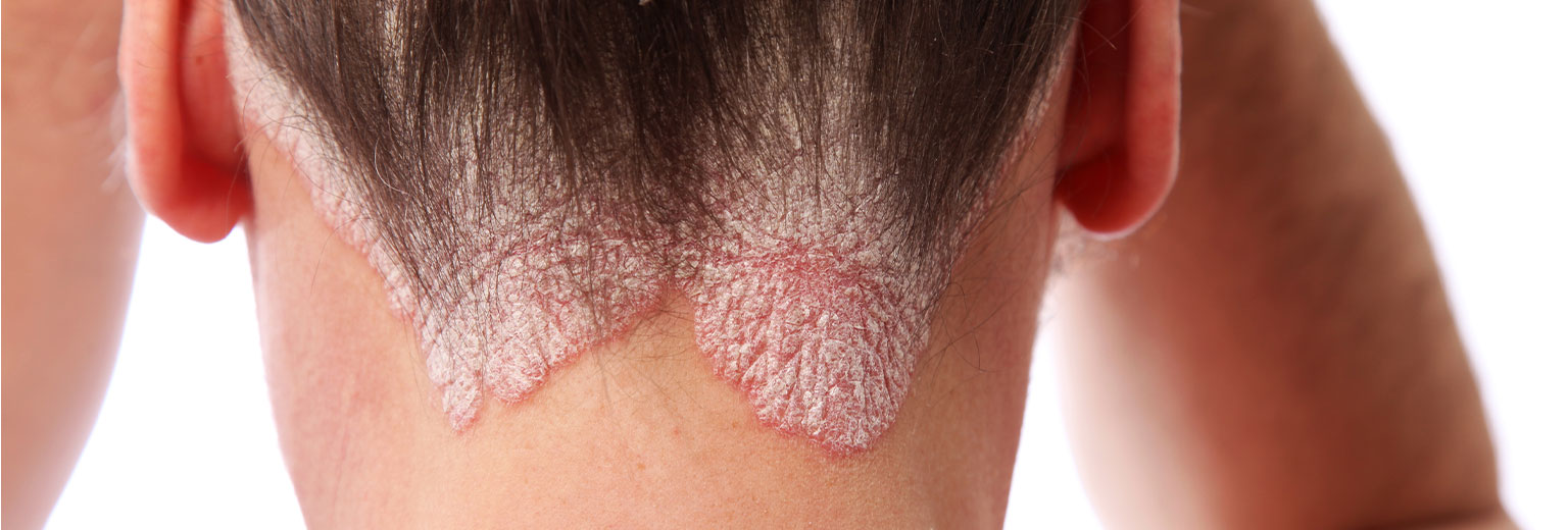Psoriasis Of The Scalp At The Hairline