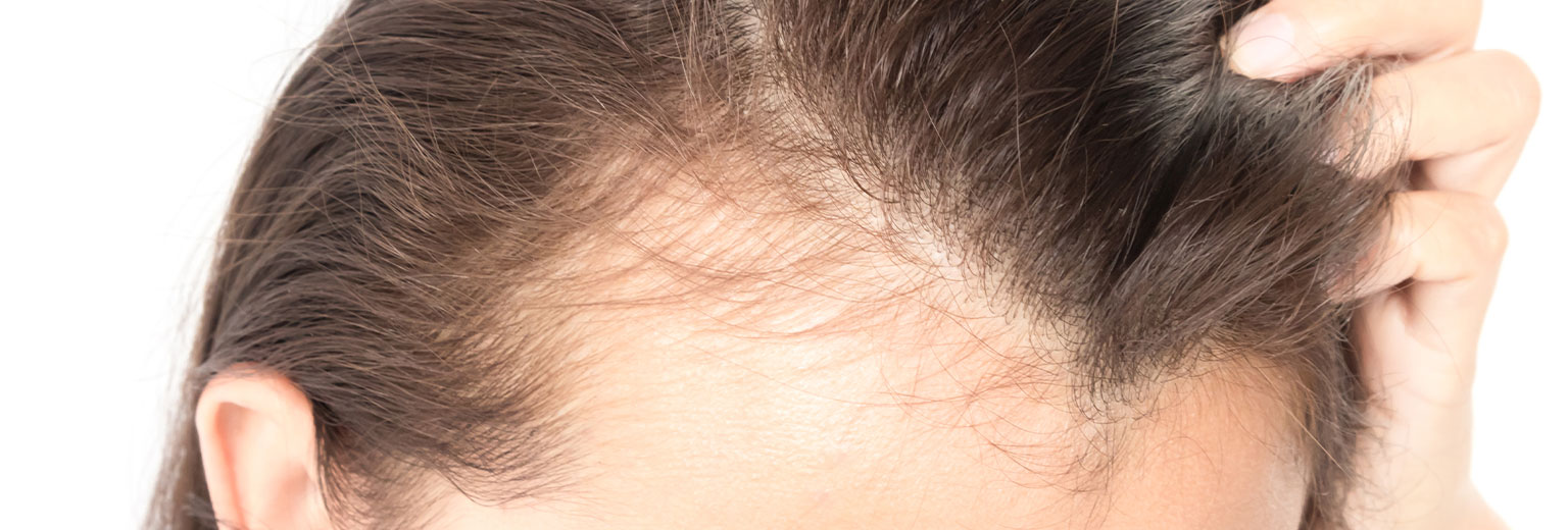 Woman serious hair loss problem for health care